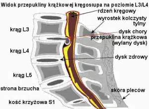 dyskopatia