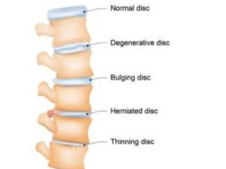 Zwyrodnienie kręgosłupa